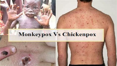 are monkeypox similar to chickenpox